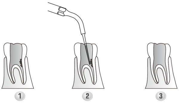 Сфера применения наконечника для скалера